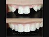 Missing Teeth? Same Day Porcelain Maryland Bridge