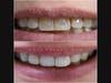 Same Day Smile Makeover