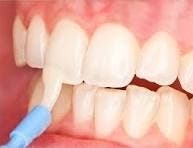 Professional fluoride varnish treatment at Dent Blanche Dental in Princeton, NJ.