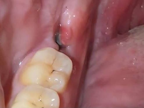 Healing wisdom tooth extraction hole showing the normal gum and socket recovery process after wisdom tooth removal.