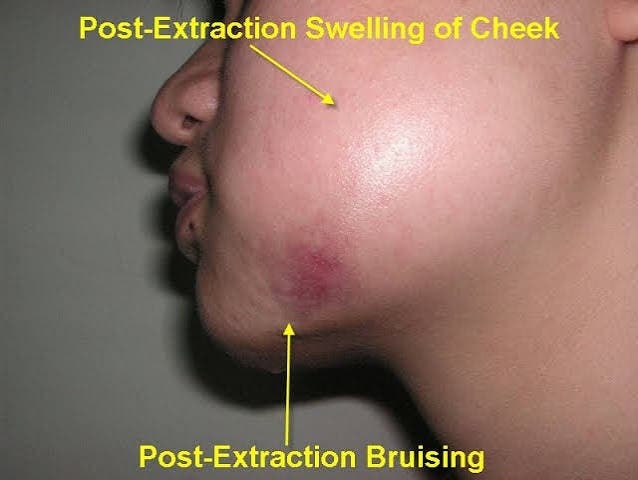 Swollen cheek after tooth extraction showing common facial swelling during dental surgery recovery.
