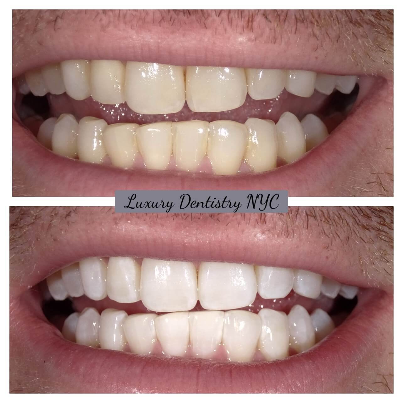 Summer Smile Event: Zoom! WhiteSpeed Professional Teeth Whitening