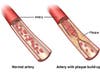 Can gum disease contribute to narrowing of the arteries?