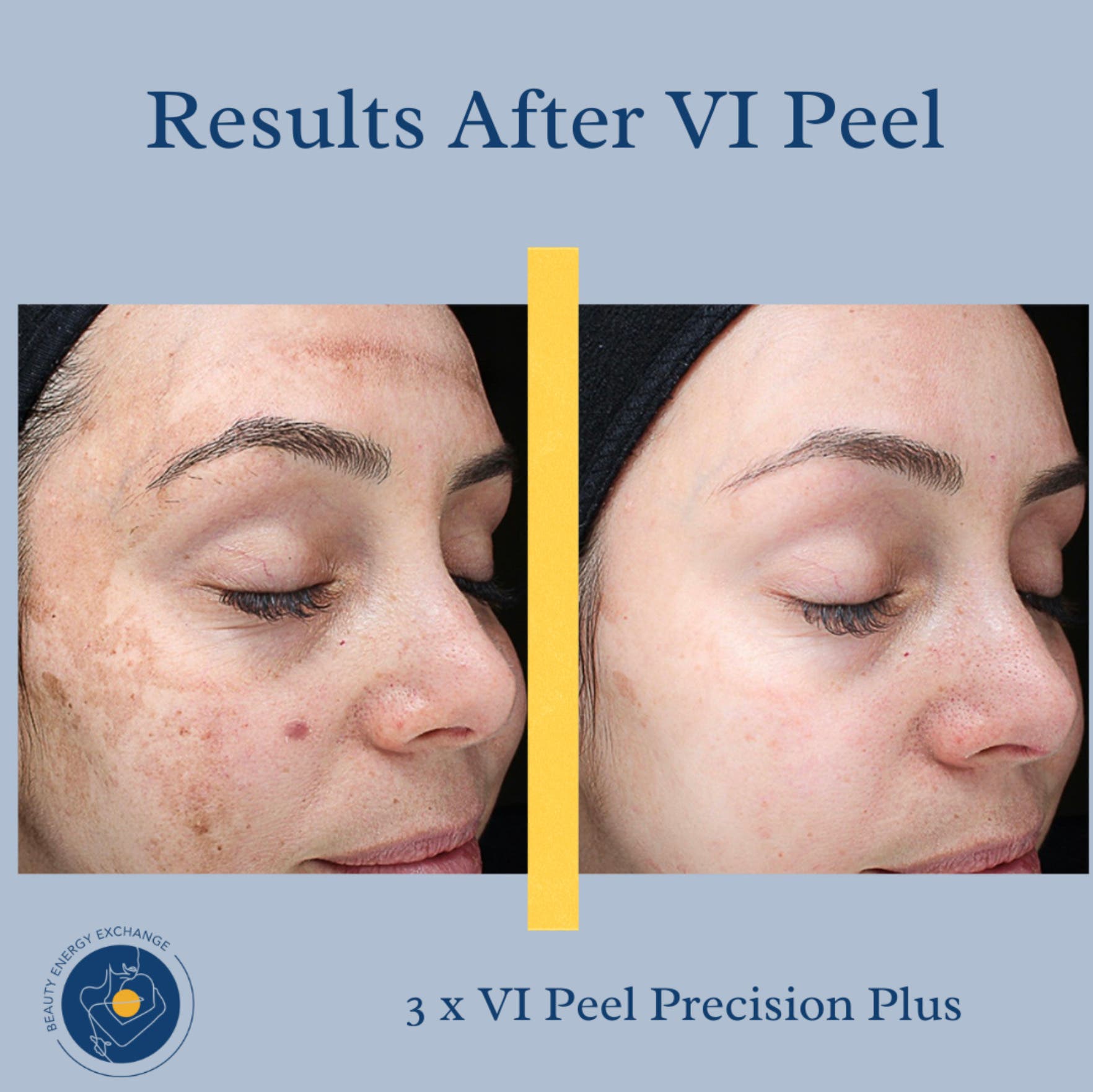 Chemical Peels in Point Loma: Glow This Spring at Beauty Energy Exchange