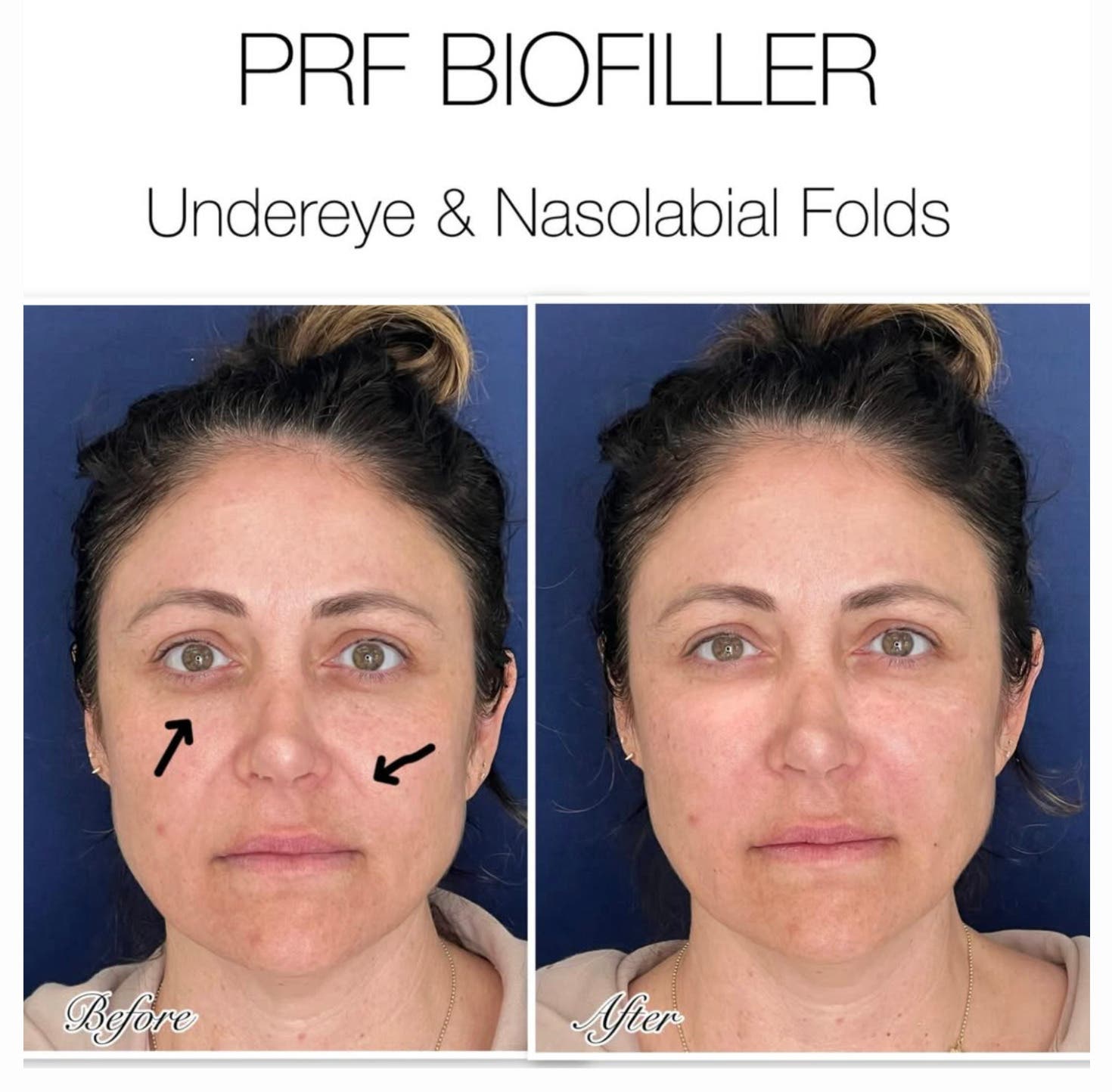 Natural Under-Eye Refresh: PRF BioFiller Intro Special - San Diego