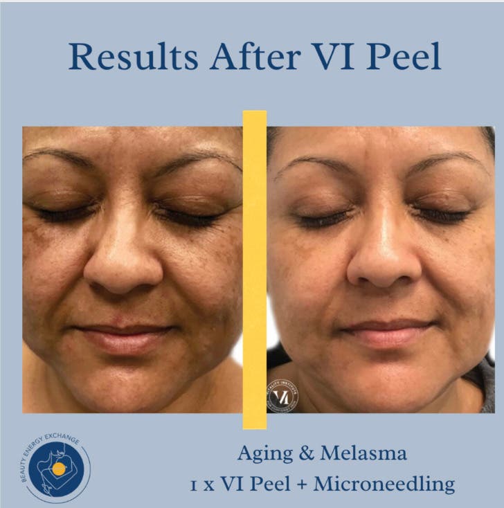 Chemical Peels San Diego | Smooth, Brighten & Refresh Your Skin