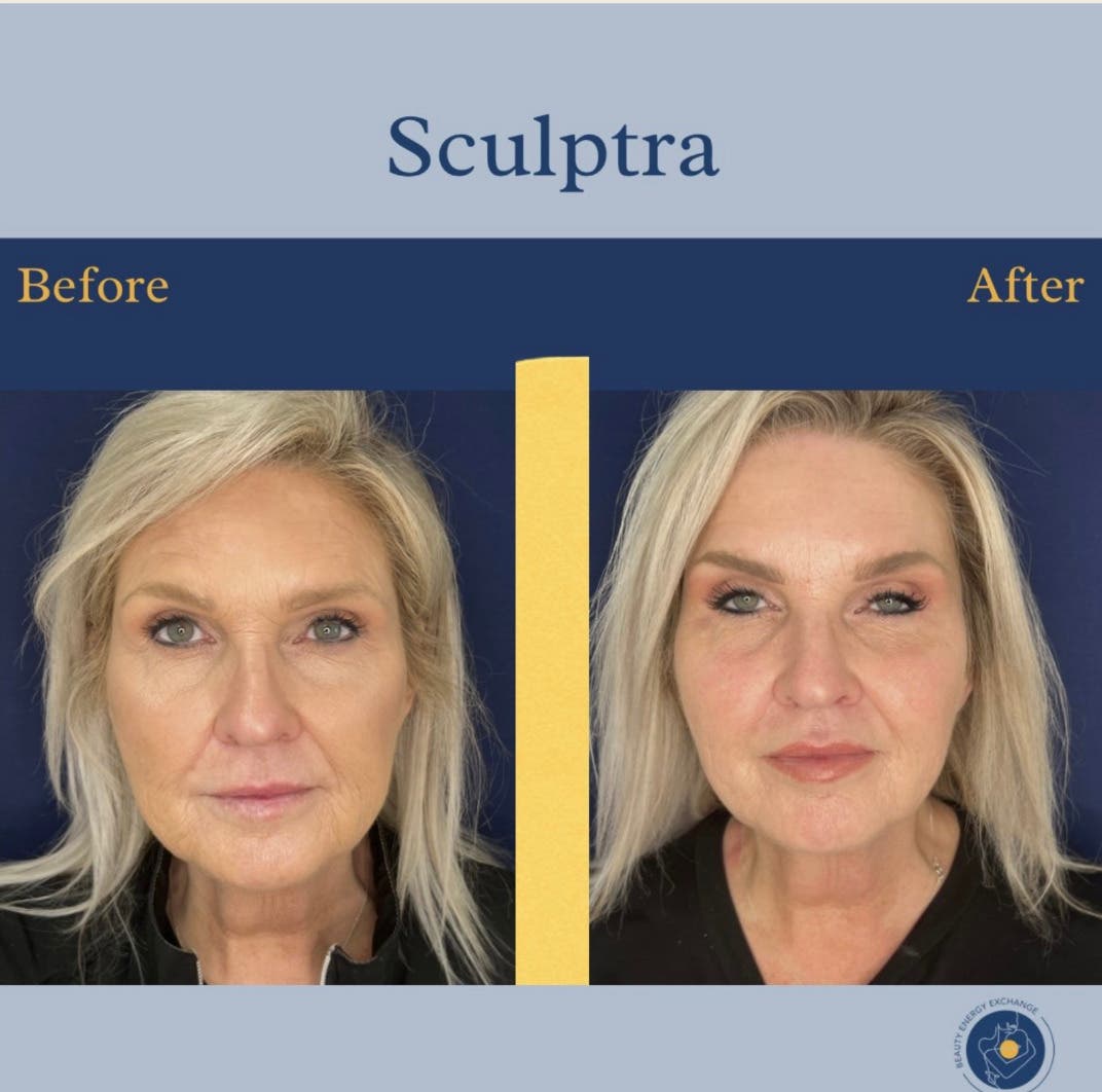 Sculptra San Diego | Natural Collagen Boosting Treatment