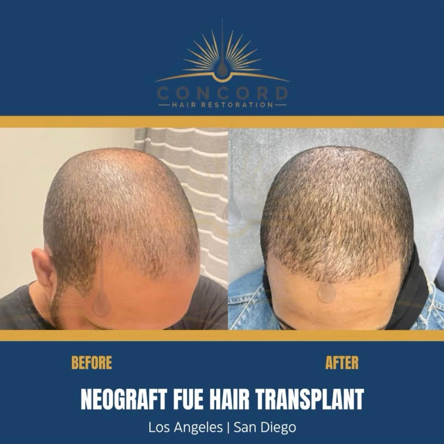 San Diego Hair Restoration Consultations Available at Concord Hair Restoration
