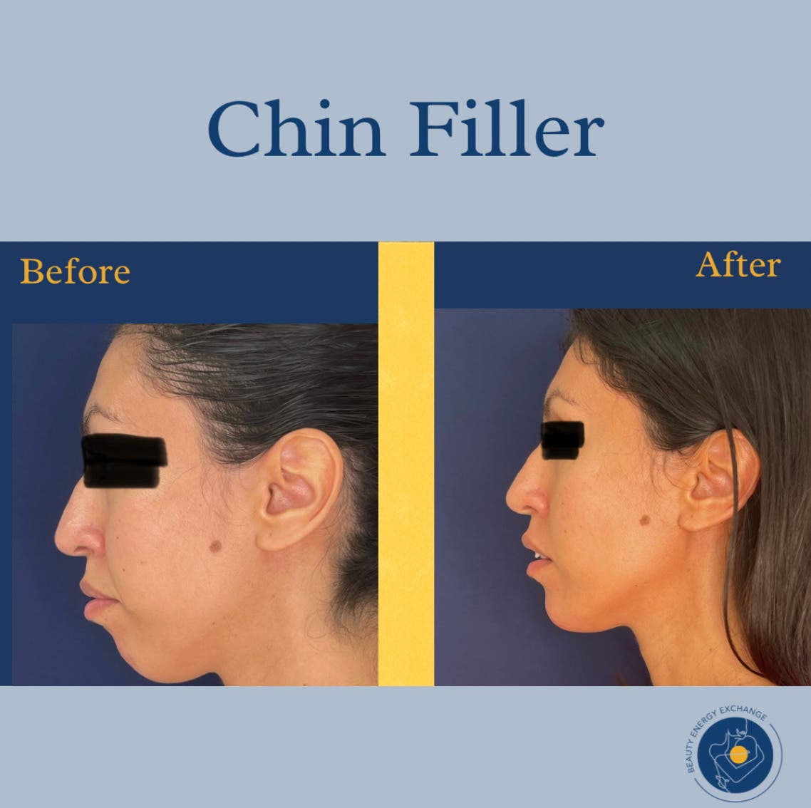 Chin Filler San Diego | Improve Facial Balance Without Surgery