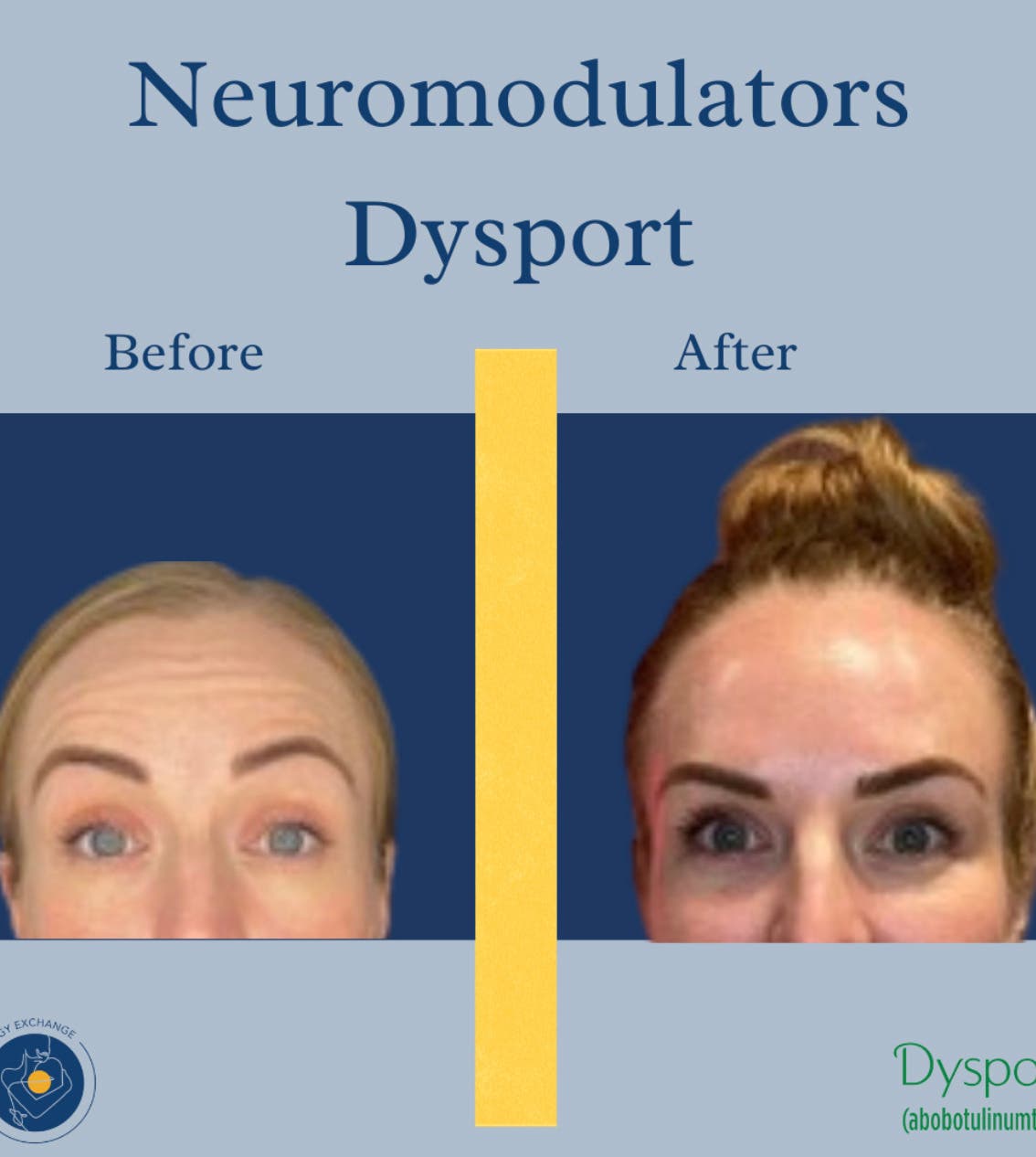 Dysport San Diego | Smooth Wrinkles While Keeping Natural Expression