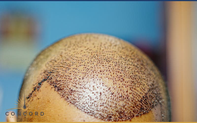 Hair Transplant Consultations Available in San Diego