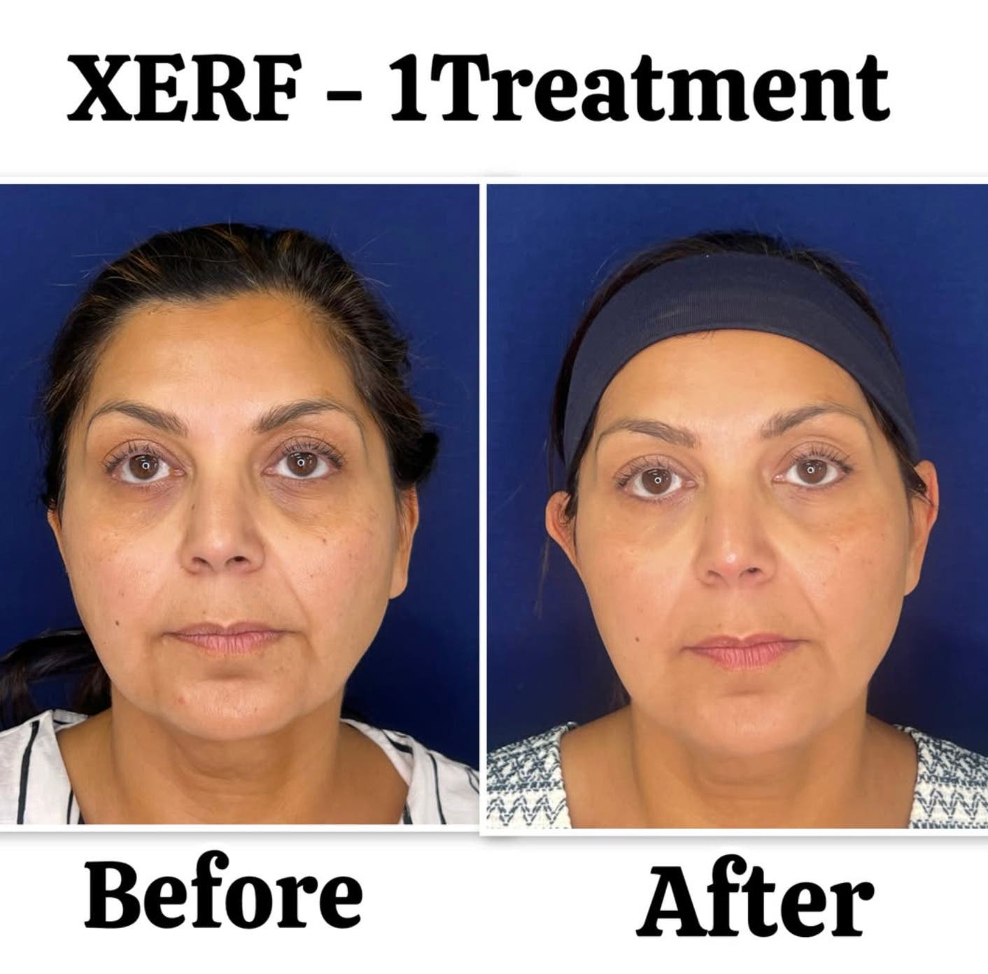 XERF Skin Tightening San Diego | Lift Loose Skin Naturally ⭐