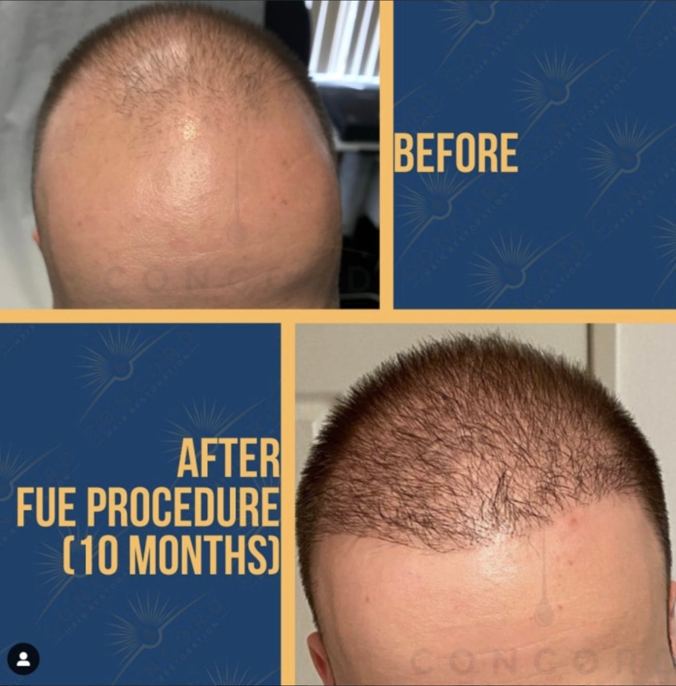 Receding Hairline? Explore Hair Transplant Options in San Diego