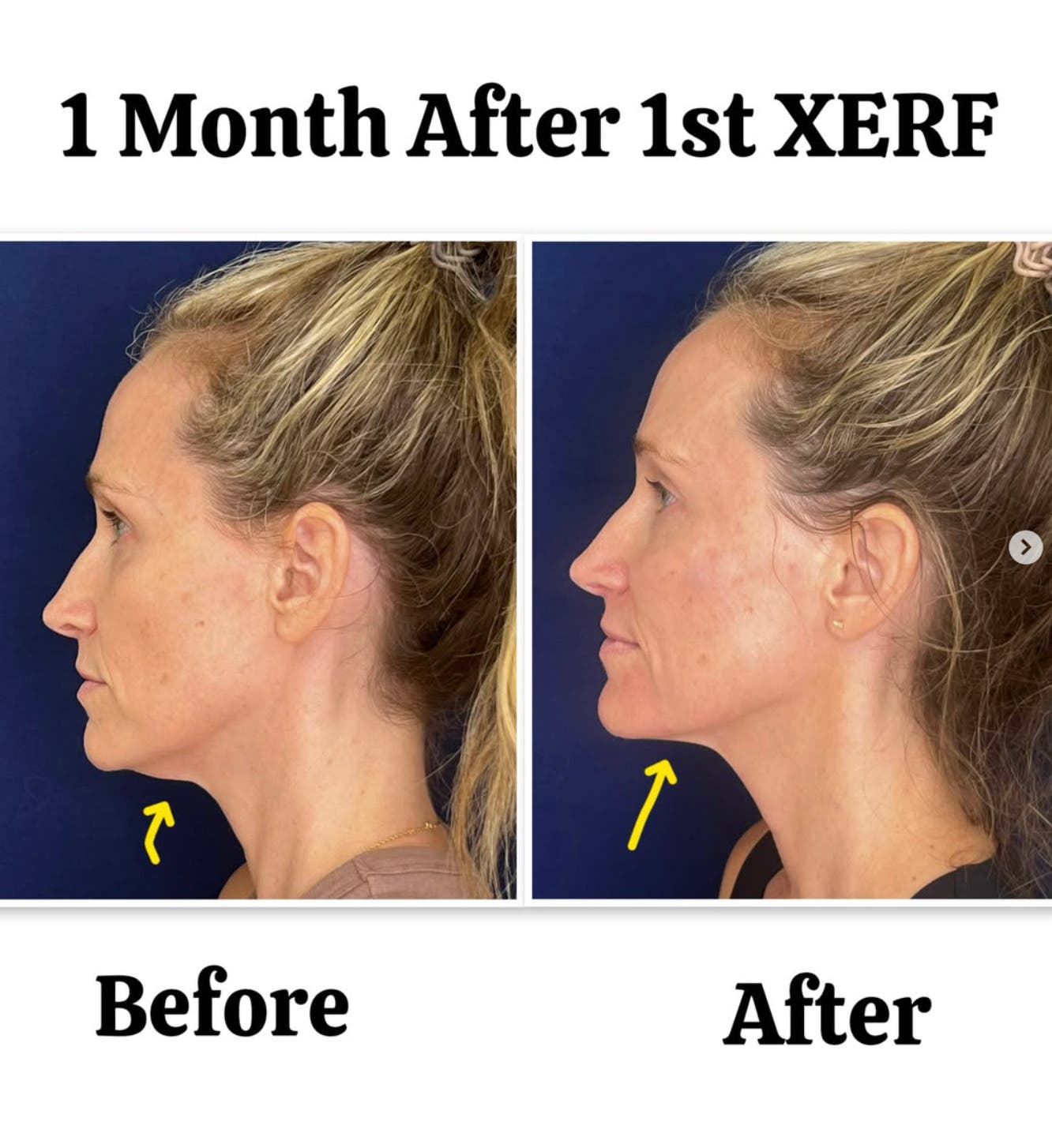 XERF Skin Tightening Now Available in Point Loma, San Diego