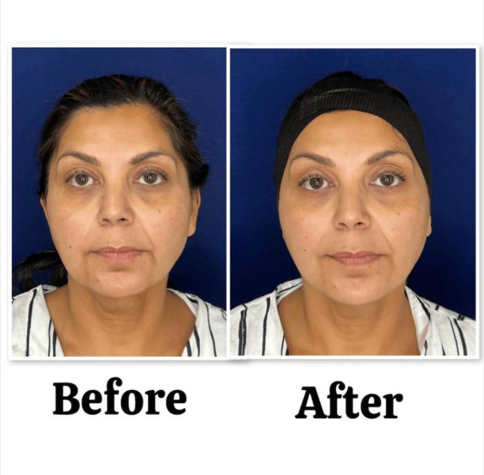 Curious About Skin Tightening Without Surgery? Meet XERF in Point Loma