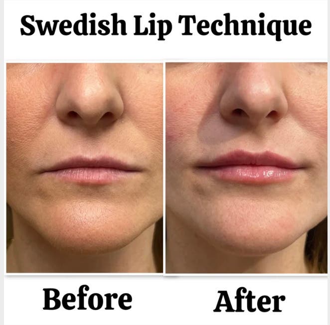 Looking for lip filler in Point Loma? Experience a personalized approach to lip enhancement