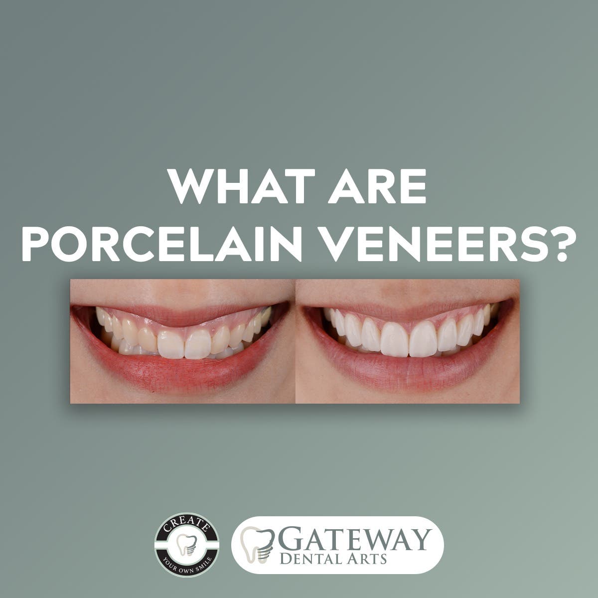 Gateway Dental Arts-Dr Richard Austin-DDS Dental Implants