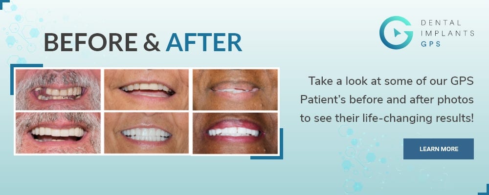 Dental Implants GPS
