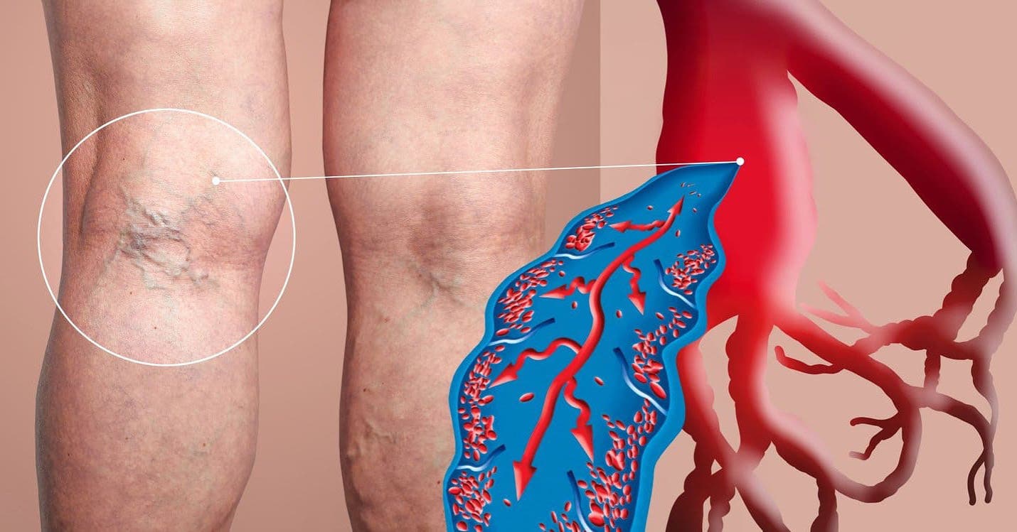 ⚠️ Important: What To Do If A Varicose Vein Bursts