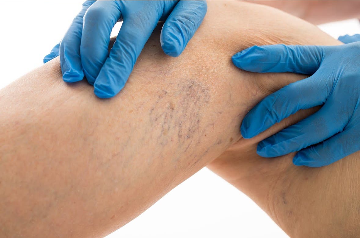 🕷️ Are Your Spider Veins Dangerous? What You Need to Know