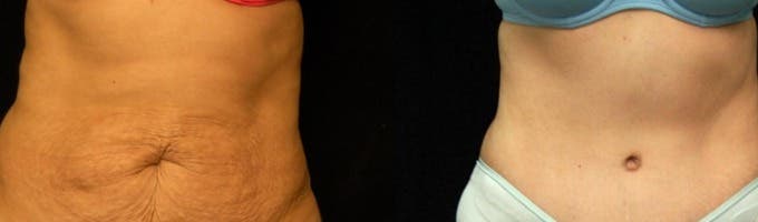 Pacific Lipo Newport Beach