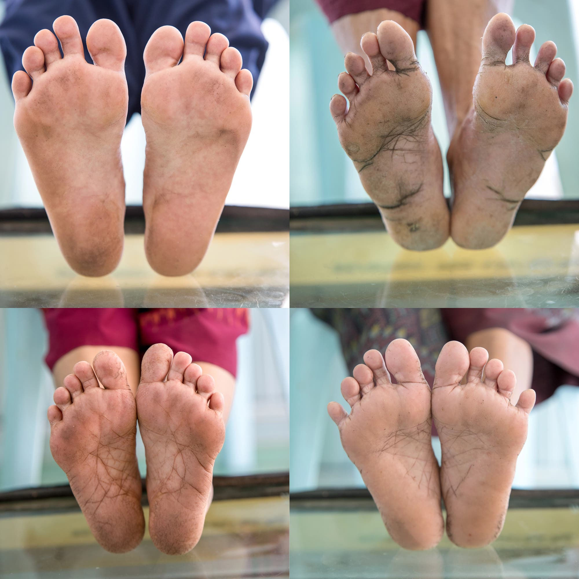Understanding Diabetic Foot Care: How an Experienced DPM Helps Protect Long-Term Foot Health
