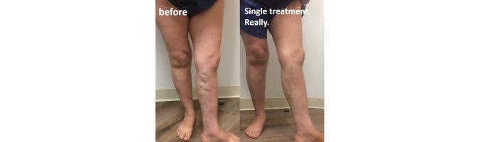 Sacramento Vein Specialists