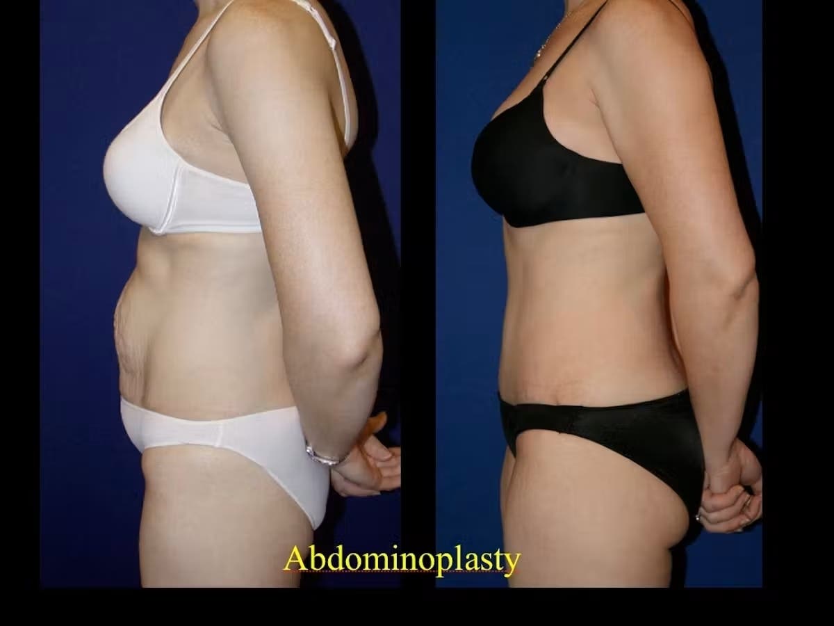 https://patch.com/img/cdn20/users/27113616/20260824/030330/styles/patch_image/public/tummy-tuck-___24145519511.jpg