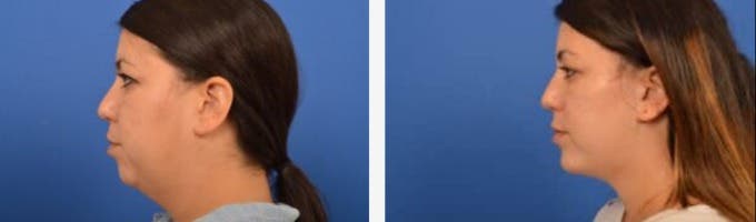 Center For Advanced Facial Plastic Surgery