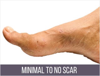 Bunion Surgery Specialists NYC