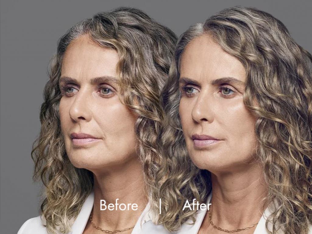 Dermal Fillers in Orange County: Enhance Cheeks, Chin & Facial Contours