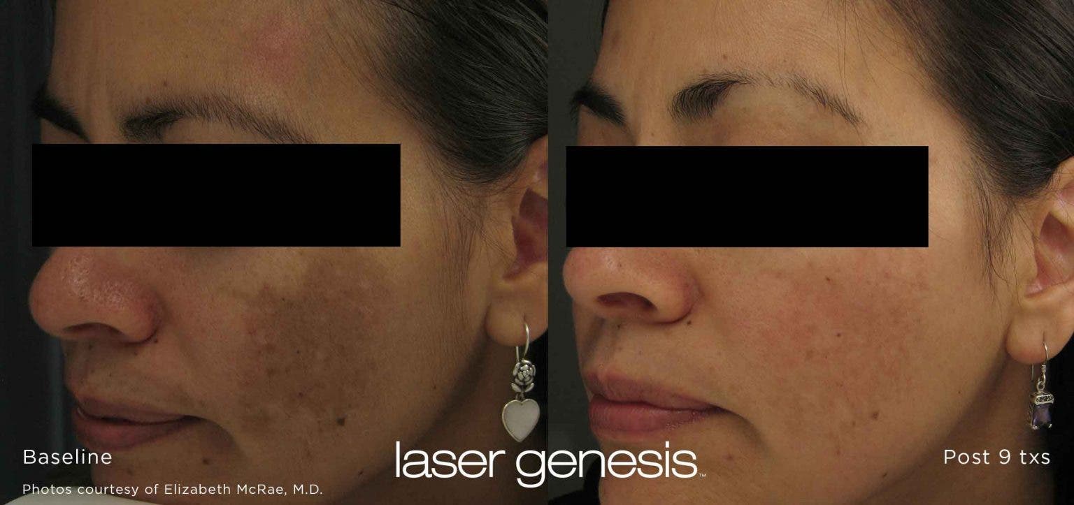  Clearer, Smoother Skin with Laser Genesis at Alladerm