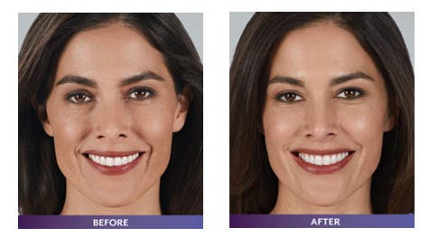 Thinking About Juvederm? Trusted Dermal Fillers in Orange County