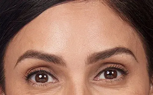 Botox in Aliso Viejo, CA - Natural-Looking Results at Alladerm