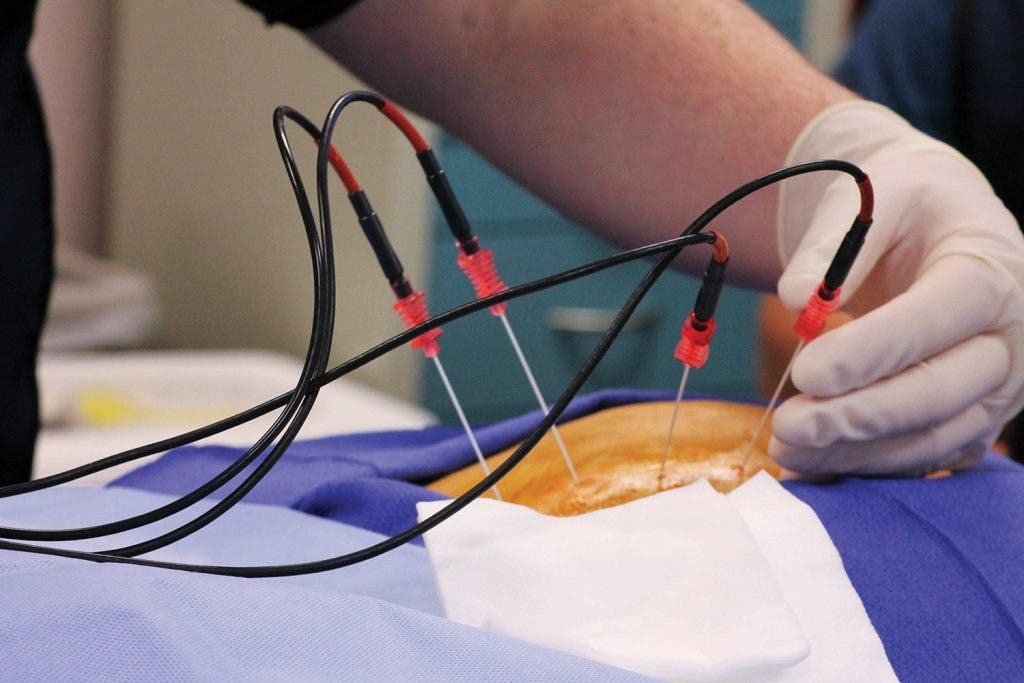 Radiofrequency Ablation for Facet Joint Back Pain: What Long Beach Patients Should Know
