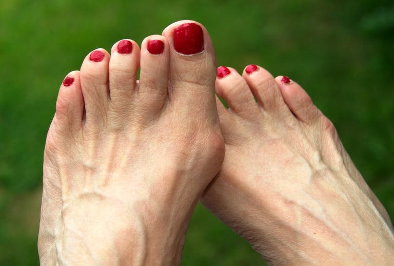 From Diagnosis to Recovery: What to Expect from Bunion Treatment Today