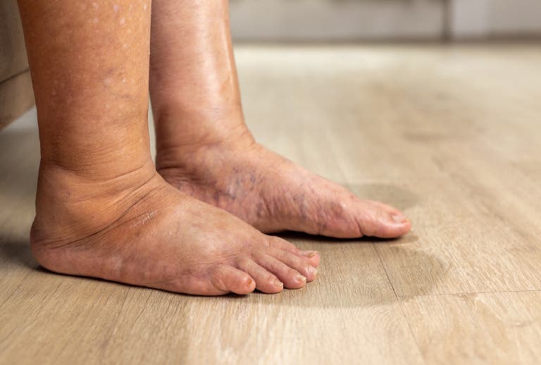 Diabetic Foot Health: Signs of Infection Patients Should Not Ignore