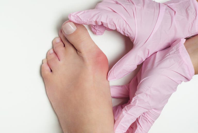Understanding Non-Surgical Bunion Treatment Before Considering Surgery