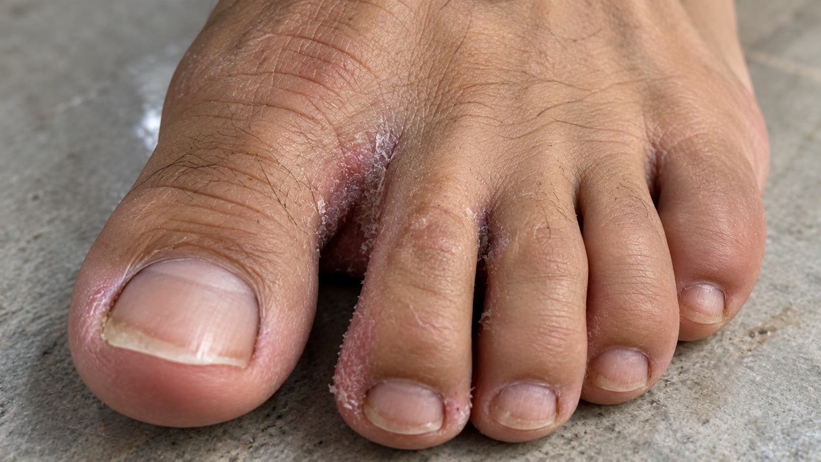 Understanding Fungal Foot Conditions and Treatment Options in Cypress