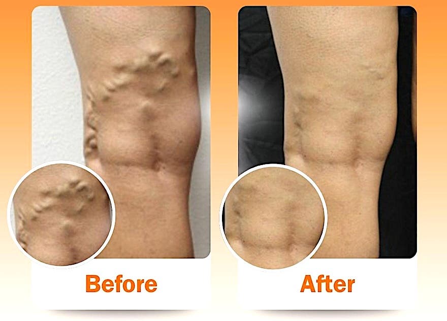 Ontario Area Women With Painful, Bulging Varicose Veins Find Relief With VenaSeal™ Treatment