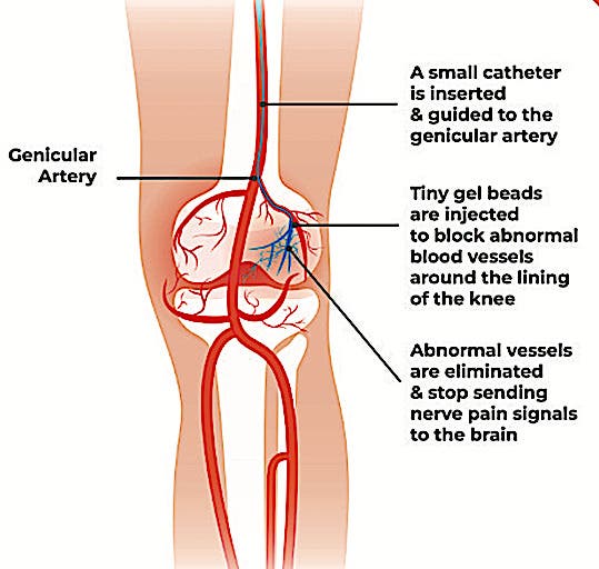 Diagram of GAE treatment for osteoarthritis of the knee