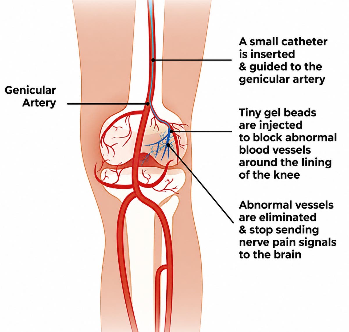 G.A.E. treatment for osteoarthritis of the knee