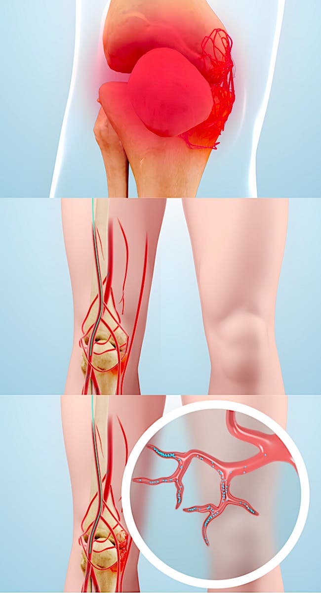 osteoarthritis of the knee and GAE treatment