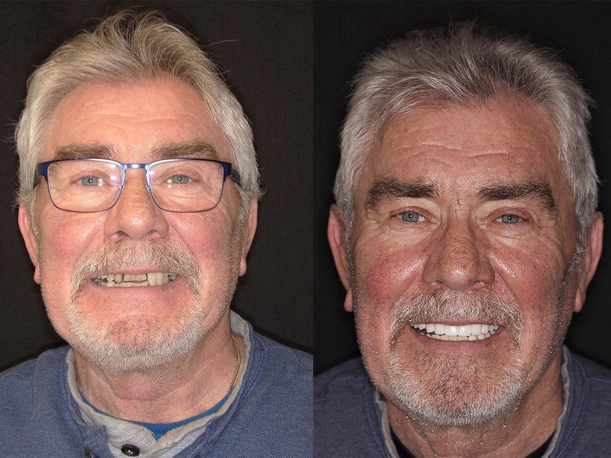 Ivan — Before (left) and After (right) full arch implant-supported restoration at Marlen Elite Dental Wellness.