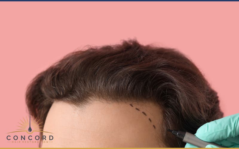 Hair Transplant Consultations Available in Los Angeles