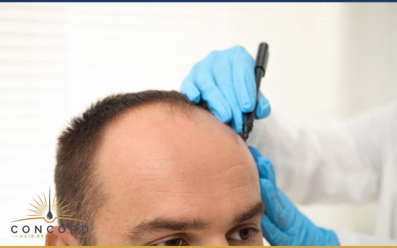 Questions About Hair Transplants in Los Angeles? Start With a Consultation