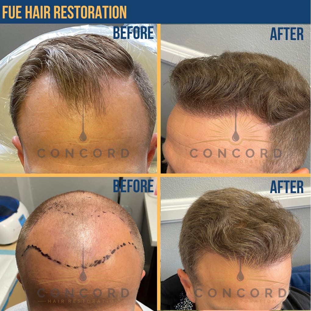 What Should You Ask Before Getting a Hair Transplant in Los Angeles?