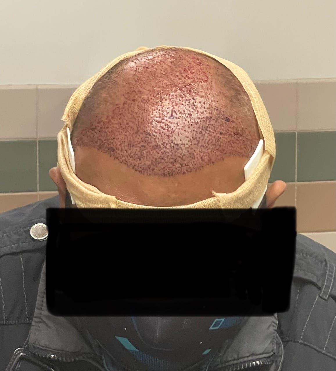 Considering a Hair Transplant in Los Angeles? Here's What Matters Most