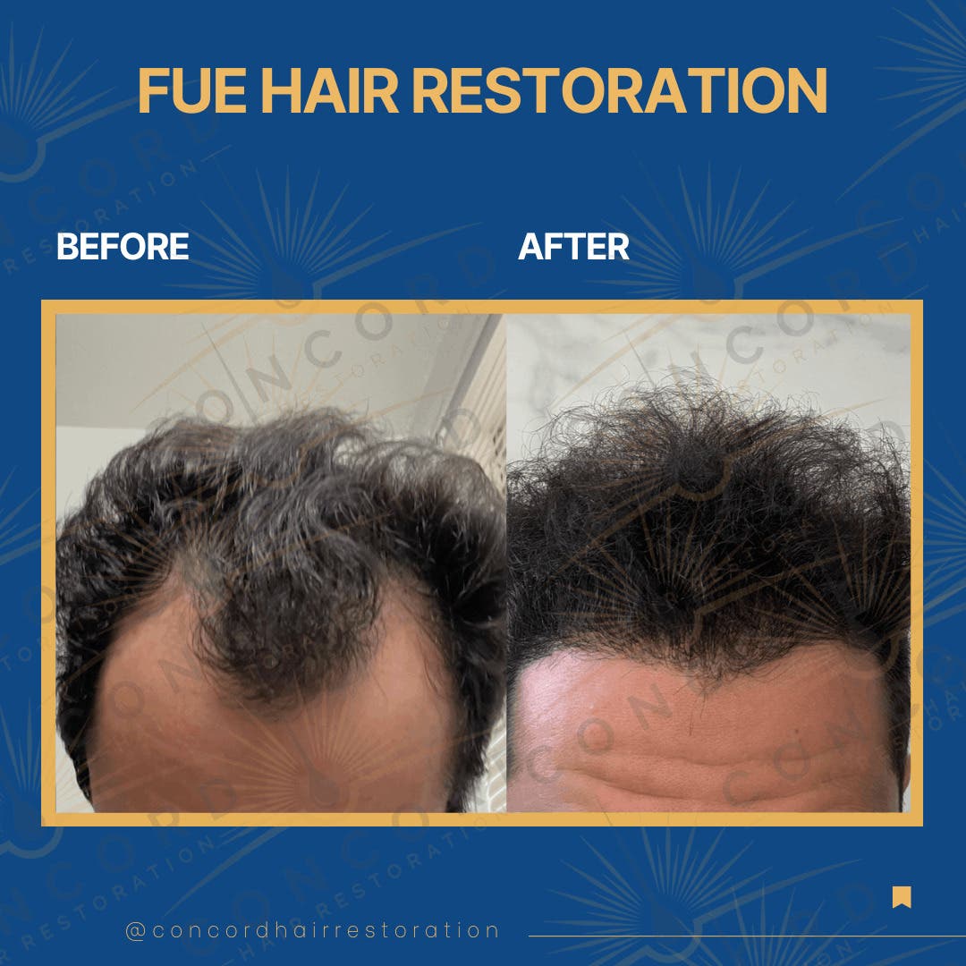 Hair Transplant Los Angeles