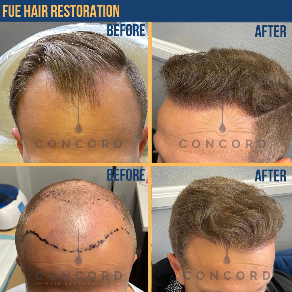 Considering a Hair Transplant in Los Angeles? Here’s What to Know